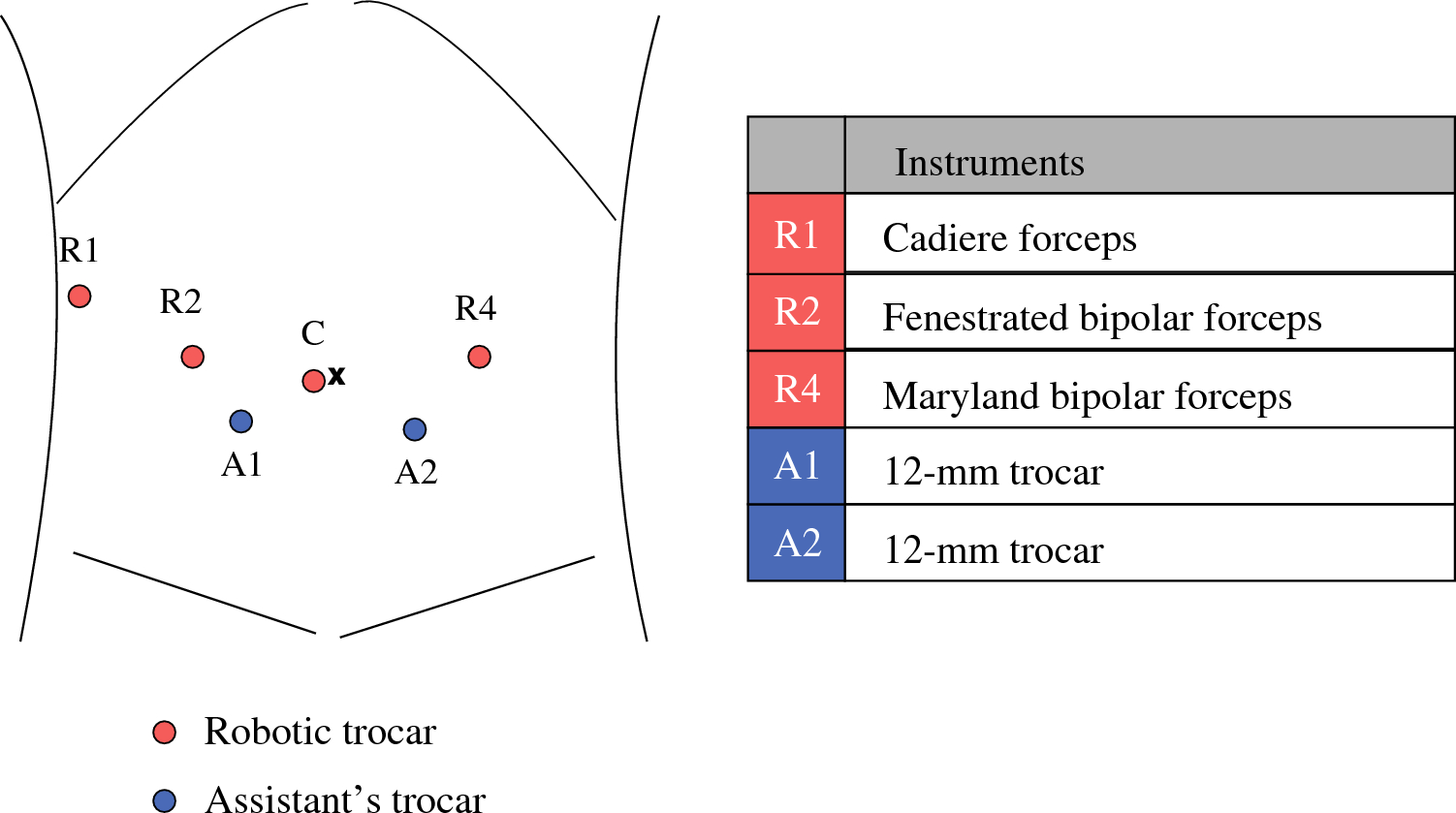 Mesenteric Route Superior Mesenteric Artery First Approach in Robot-Assisted Pancreatoduodenectomy