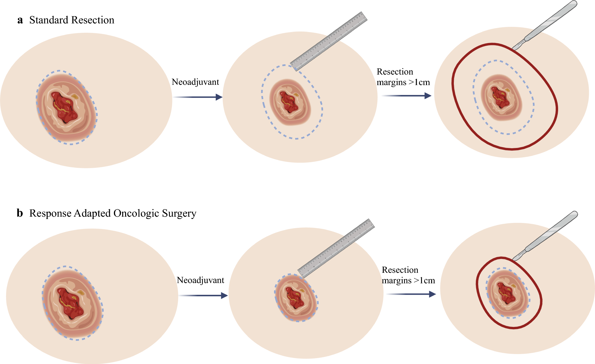 Response-Adapted Oncologic Surgery in Cutaneous Squamous Cell Carcinoma: A Paradigm Shift Following Neoadjuvant Immunotherapy