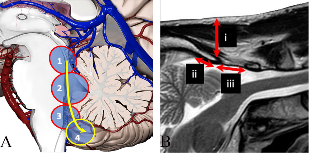 A low-angle trans-magendie foraminal approach to the fourth ventricle and dorsal brainstem