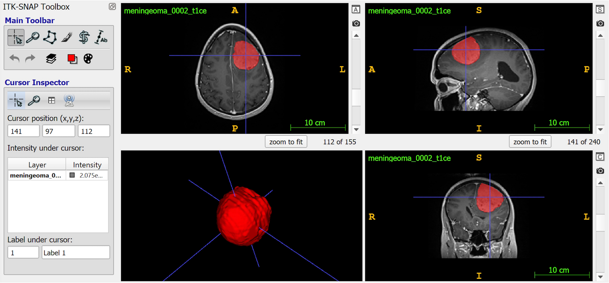 Consistency and grade prediction of intracranial meningiomas based on fractal geometry analysis