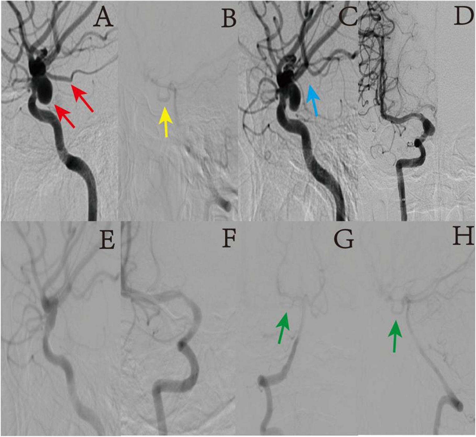 The impact of circle of Willis integrity and variations on clinical and radiological outcomes after posterior communicating arteries covered by flow diverter devices