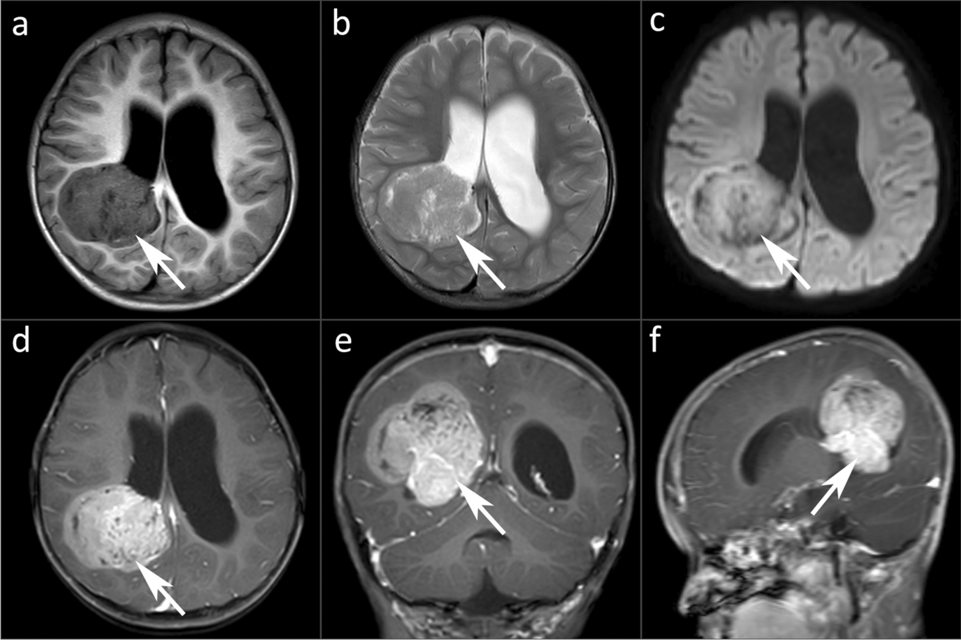 A rare pediatric case of Li-Fraumeni syndrome presenting with virilization symptoms and dual primary malignancies on magnetic resonance imaging and [F]-fluorodeoxyglucose positron emission tomography/computed tomography