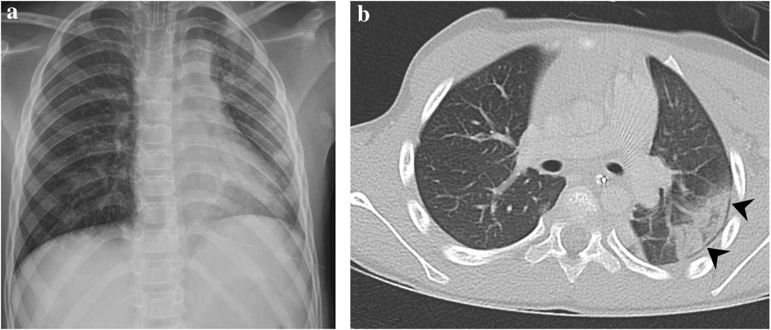 Imaging in pediatric blunt thoracic trauma