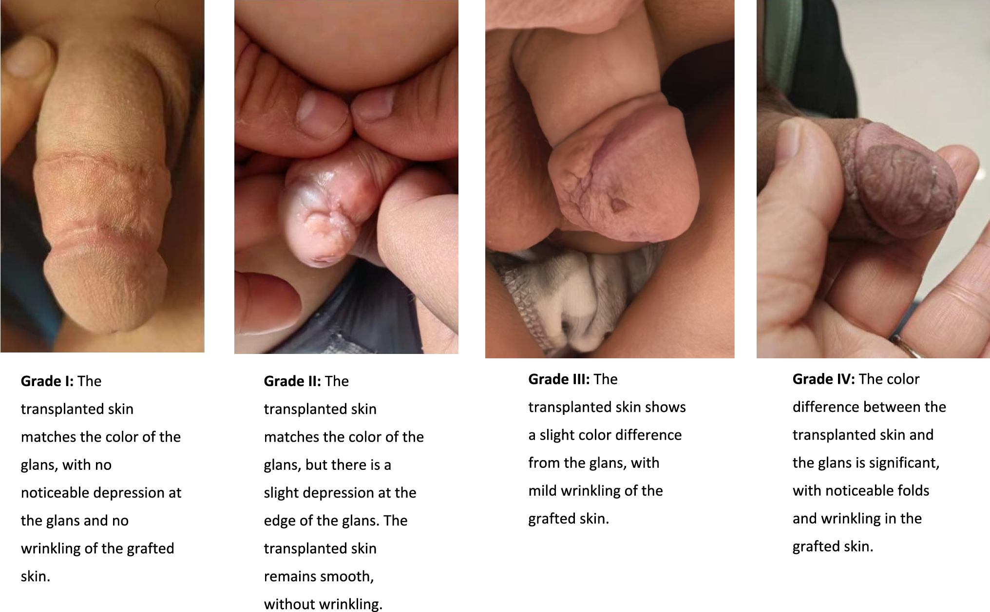 Prognosis and surgical experience of inner foreskin free grafting for the treatment of penile divided nevus in children