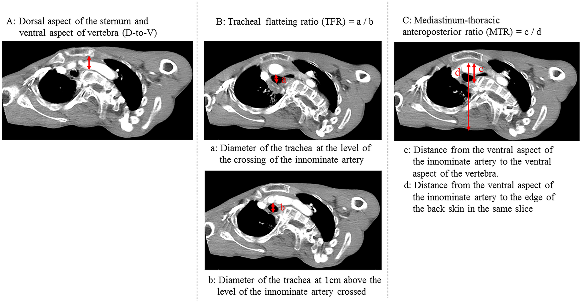 What evaluation criteria for prophylactic innominate artery transection were appropriate in the neurologically impaired patients who require laryngotracheal separation?