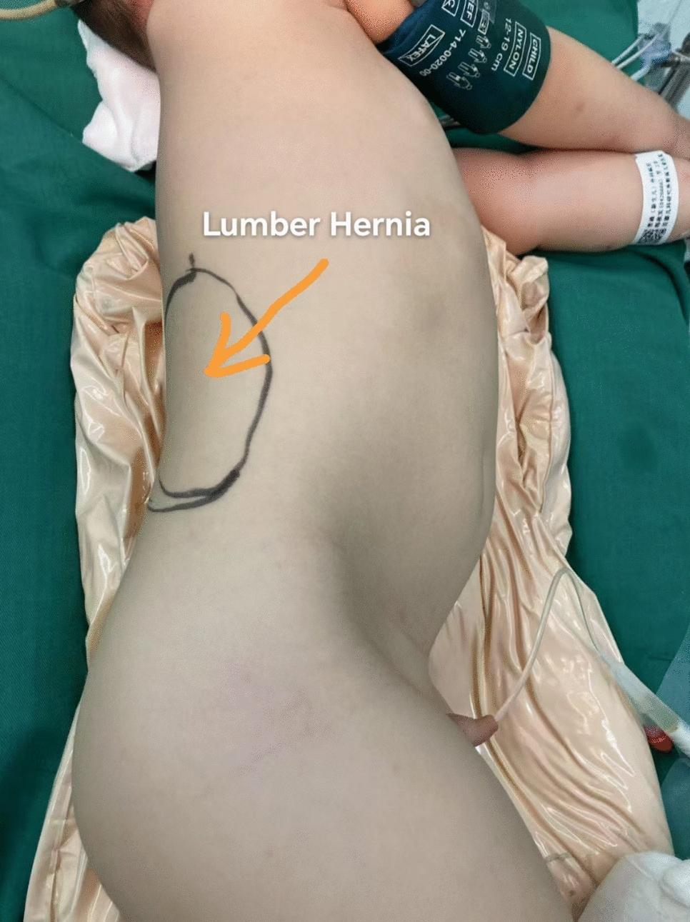 Laparoscopic surgery for lumbar hernia in children