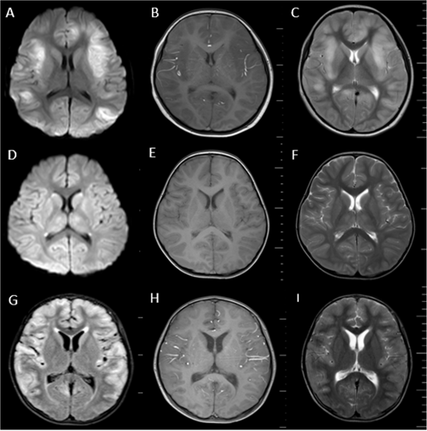 Human herpes virus-7-related severe encephalitis diagnosed using mNGS in immunocompetent pediatric patients