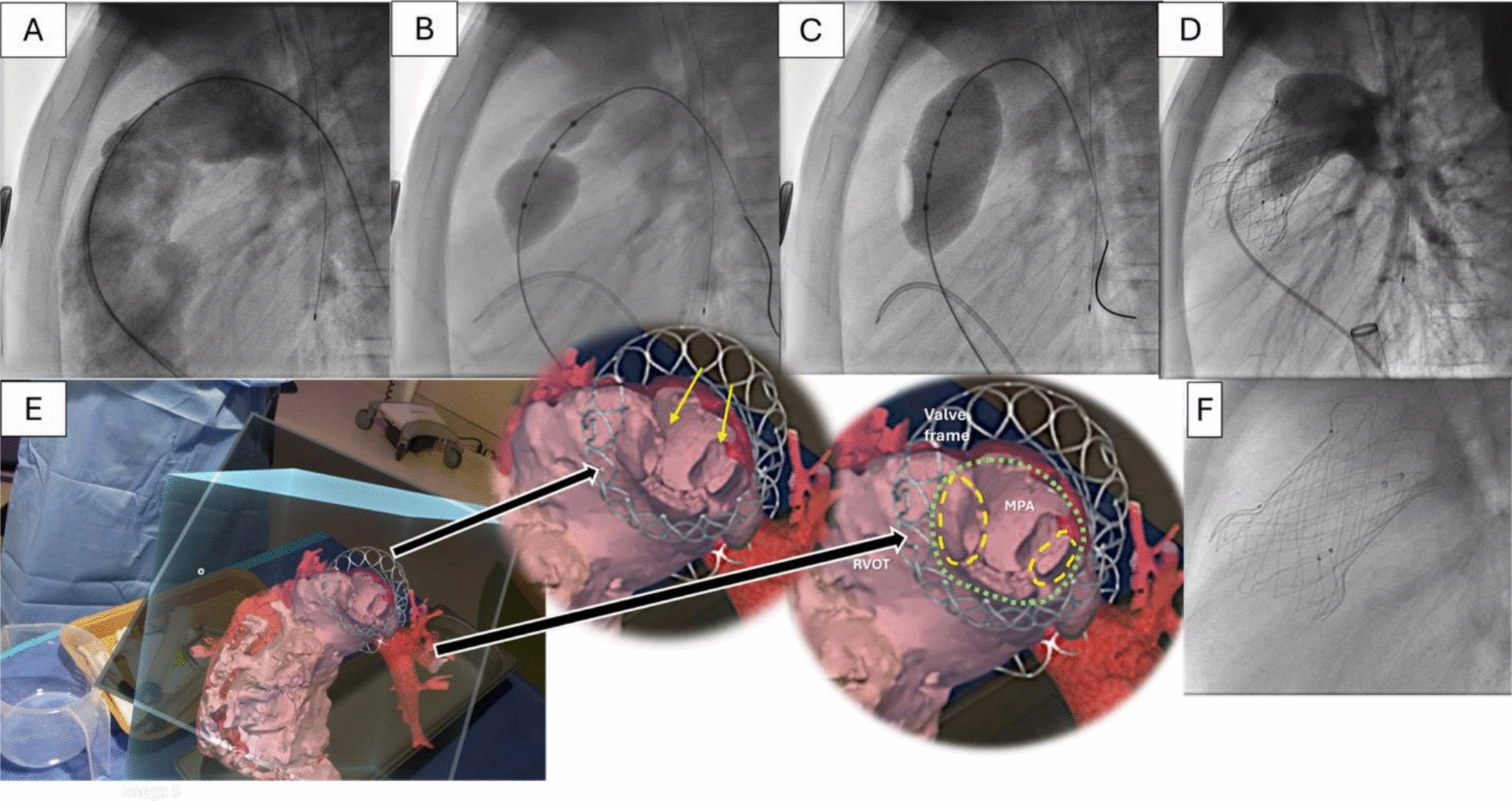 Augmented Reality Application in a Complex Case of Self-Expanding Transcatheter Pulmonary Valve Implantation