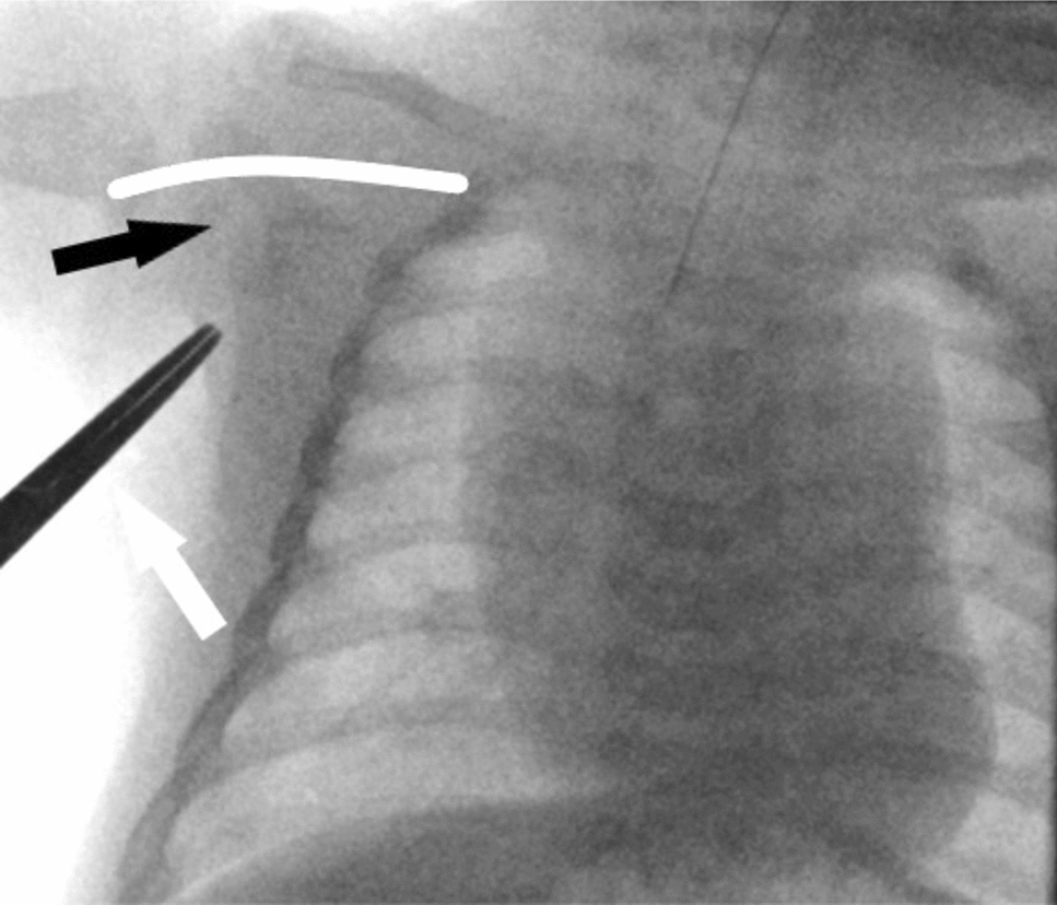 Right Axillary Artery Access for Aortic Valvuloplasty in Infants Under One Year: A Focus on Procedural Technique