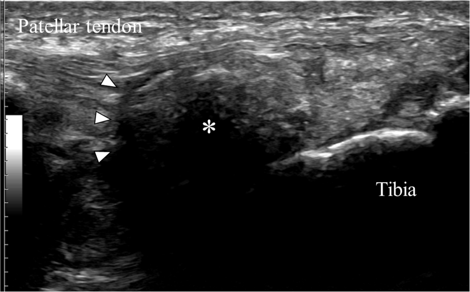 Tophaceous gout of the knee: successful treatment with transarterial microembolization