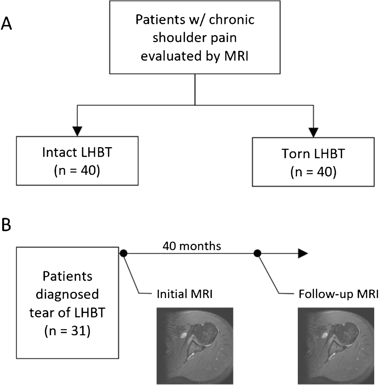 Shallowing of the bicipital groove as a sequela of long head biceps tendon tear