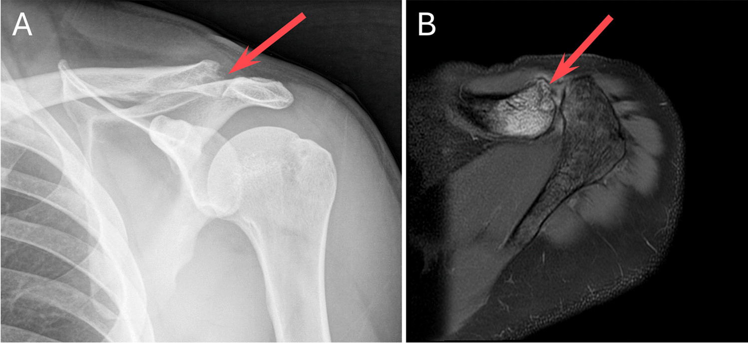 Involvement of the acromion in cases of distal clavicular osteolysis