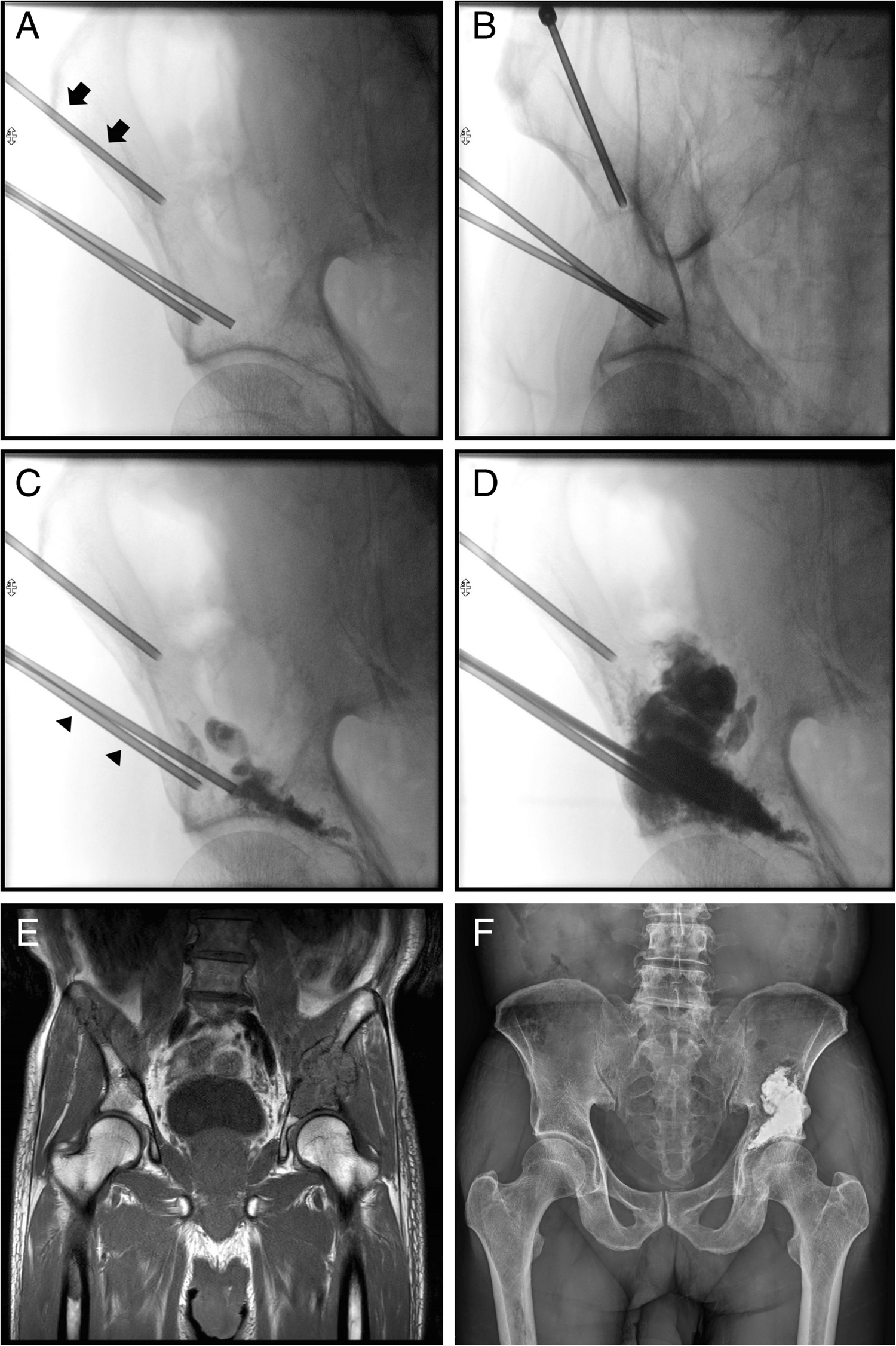 Mechanisms and protective factors of pulmonary cement embolism associated with percutaneous cementoplasty for bone metastasis in the pelvis: A retro-prospective study