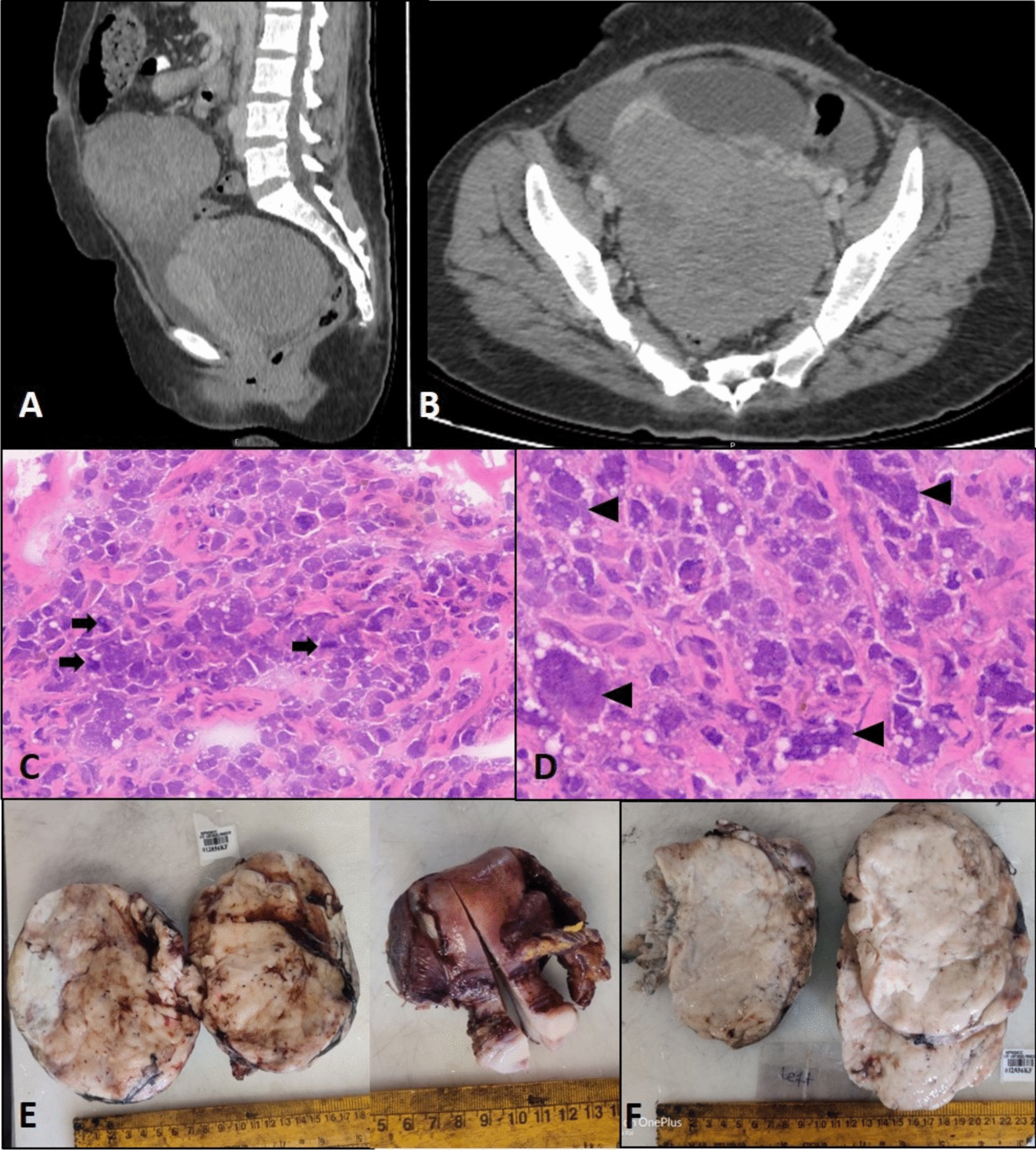 “When Ovarian Malignancy Isn’t What It seems”: Primary Ovarian Lymphomas Mimicking Epithelial Cancer—A Single-Institution Experience with a Summary of Prior Published Cases