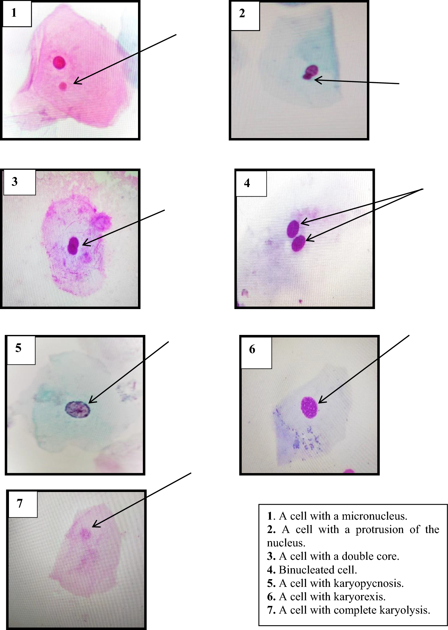 Cytogenetic evaluation of vaginal and buccal epithelium of pregnant women living in conditions of radioactive, chemical and combined environmental contamination