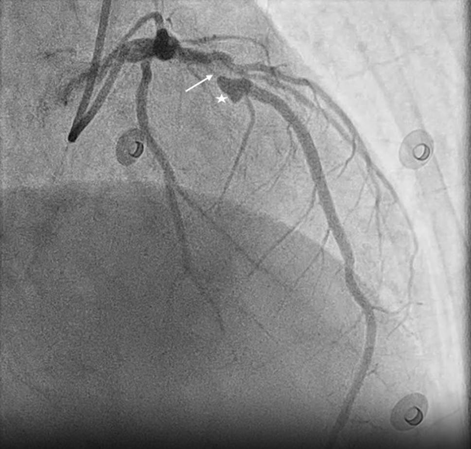 A heart shaped coronary aneurysm
