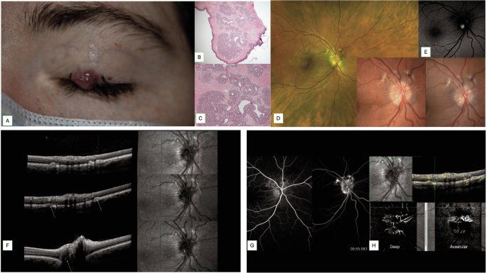 Ophthalmological manifestations in a cohort of Cowden syndrome patients in a large tertiary healthcare system