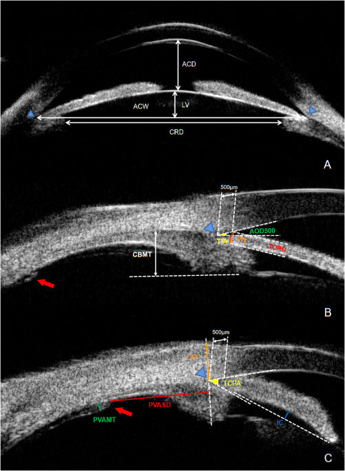 Peripheral vitreoretinal abnormality and its correlation with malignant glaucoma in nanophthalmos with secondary angle closure glaucoma