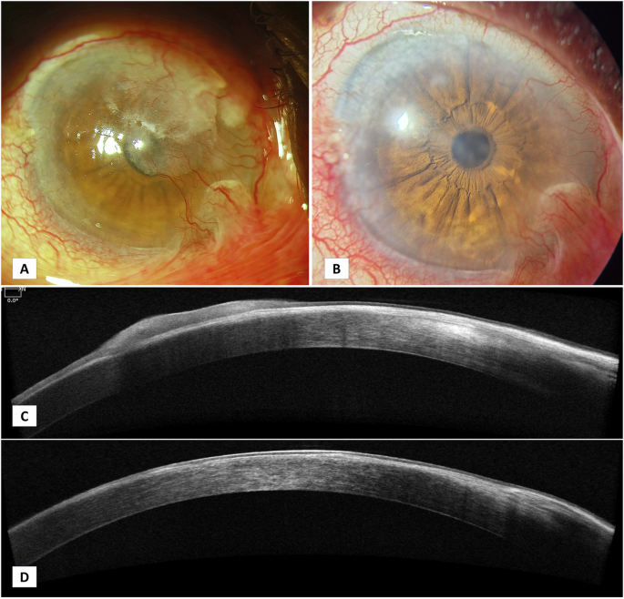 Rapid remission of extensive corneal surface neoplasia with topical interferon therapy