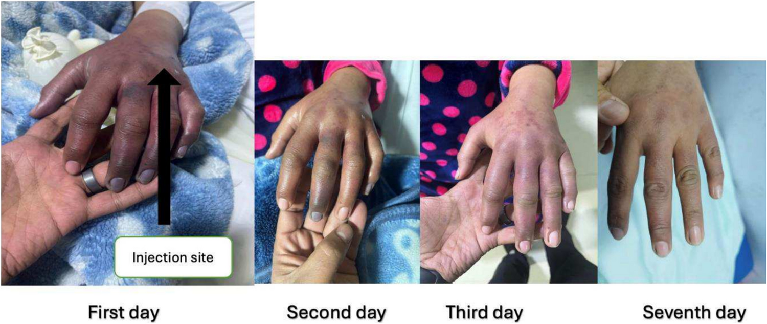 Stellate Ganglion Block for Management of Nicolau’s Syndrome Following Intravenous Ibuprofen Injection: a Case Report and Literature Review