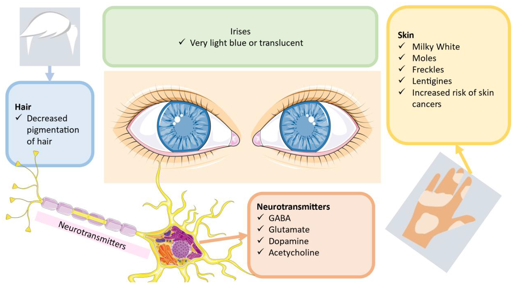 Strabismus and nystagmus in oculocutaneous albinism: clinical perspectives, diagnosis, and role of neurotransmitters