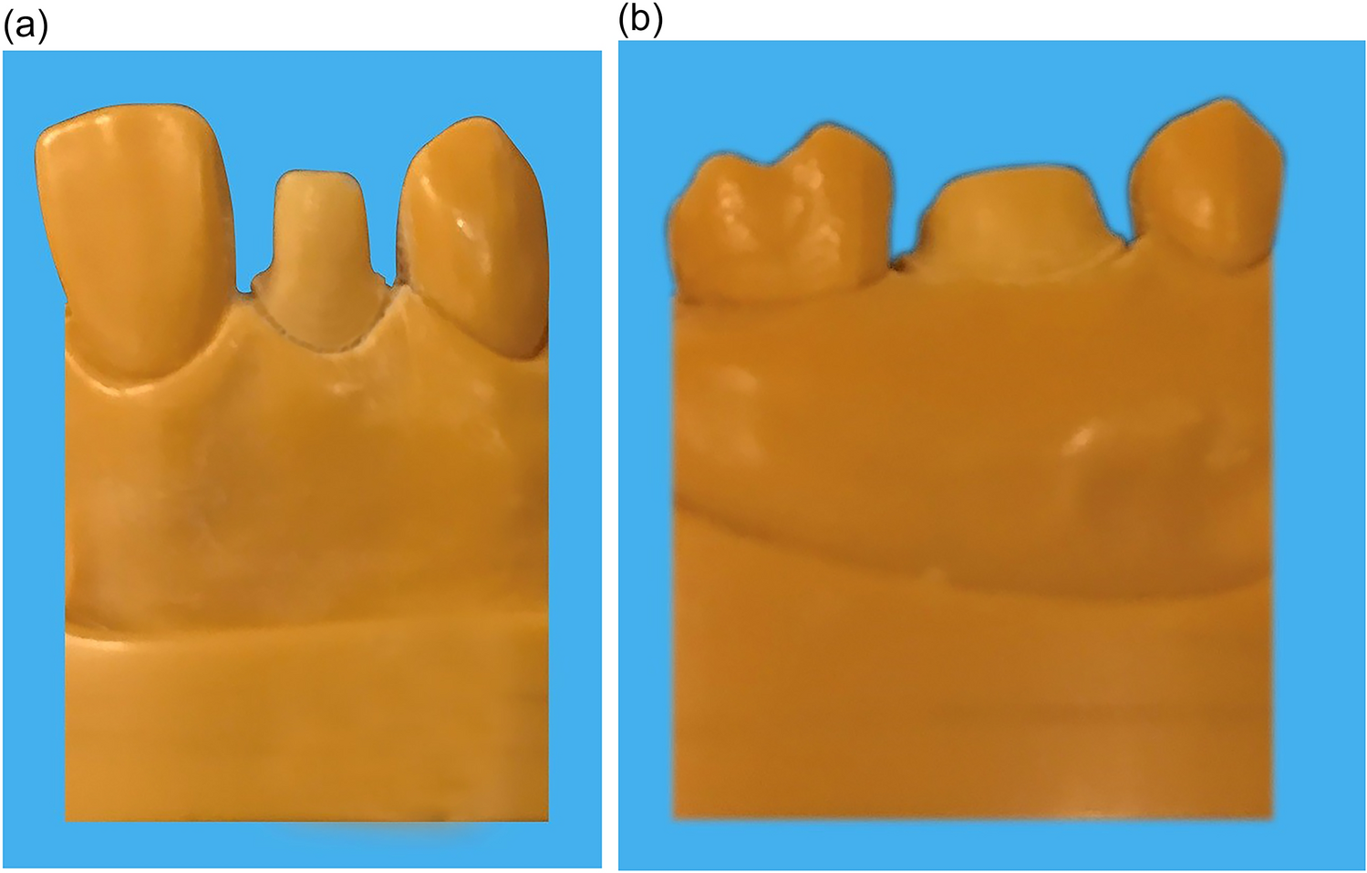 Overall fit of anterior and posterior single crown substructures fabricated with different additive manufacturing and conventional techniques