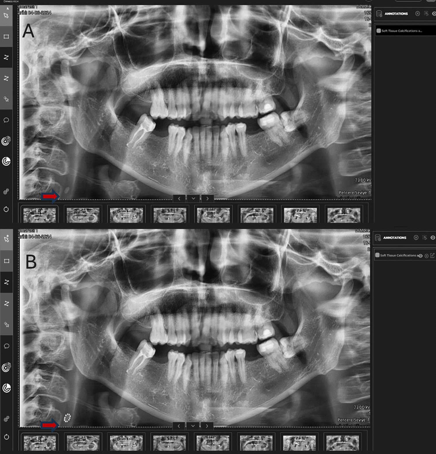 Evaluation of deep learning-based segmentation models for carotid artery calcification detection in panoramic radiographs
