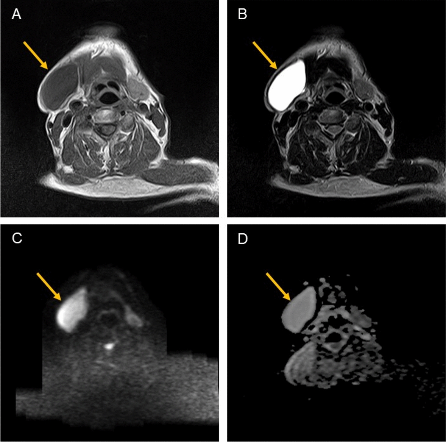 Apparent diffusion coefficient for distinguishing between benign and malignant lesions in submandibular and sublingual spaces