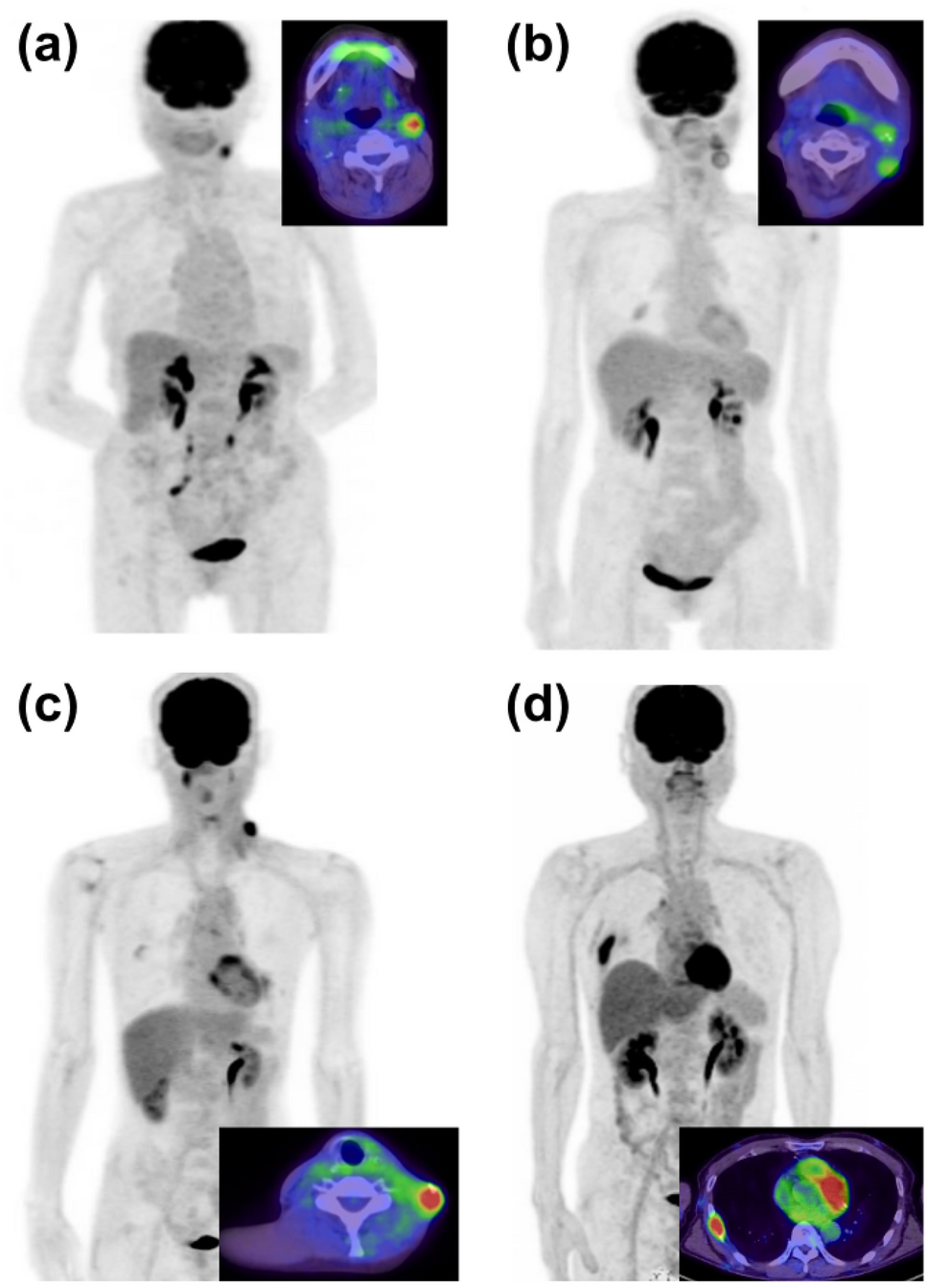 Treatment response assessment in resistant oral squamous cell carcinoma applying F-FDG PET/CT with reference to the Lugano classification