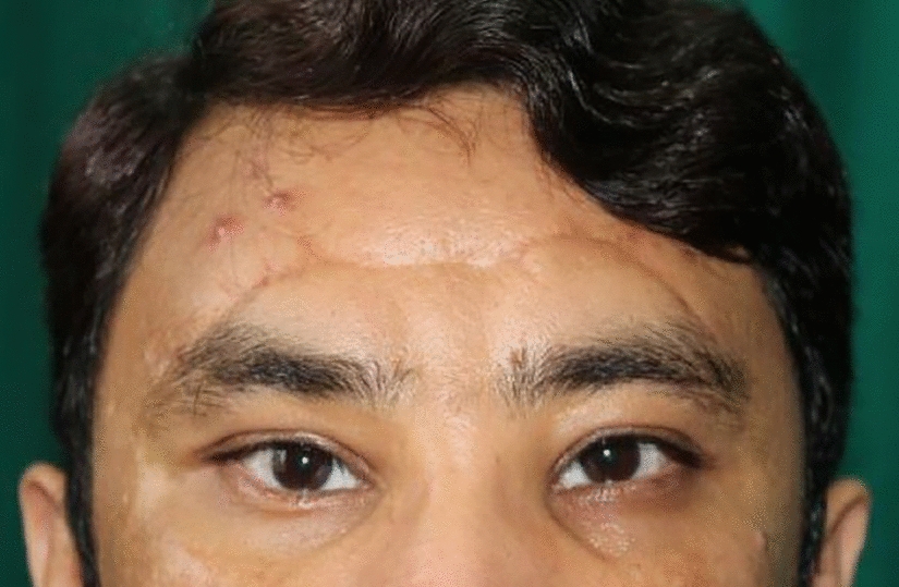 A rare case of respiratory epithelial lined sinus retention cyst in the orbital floor reporting 22 years after orbital trauma