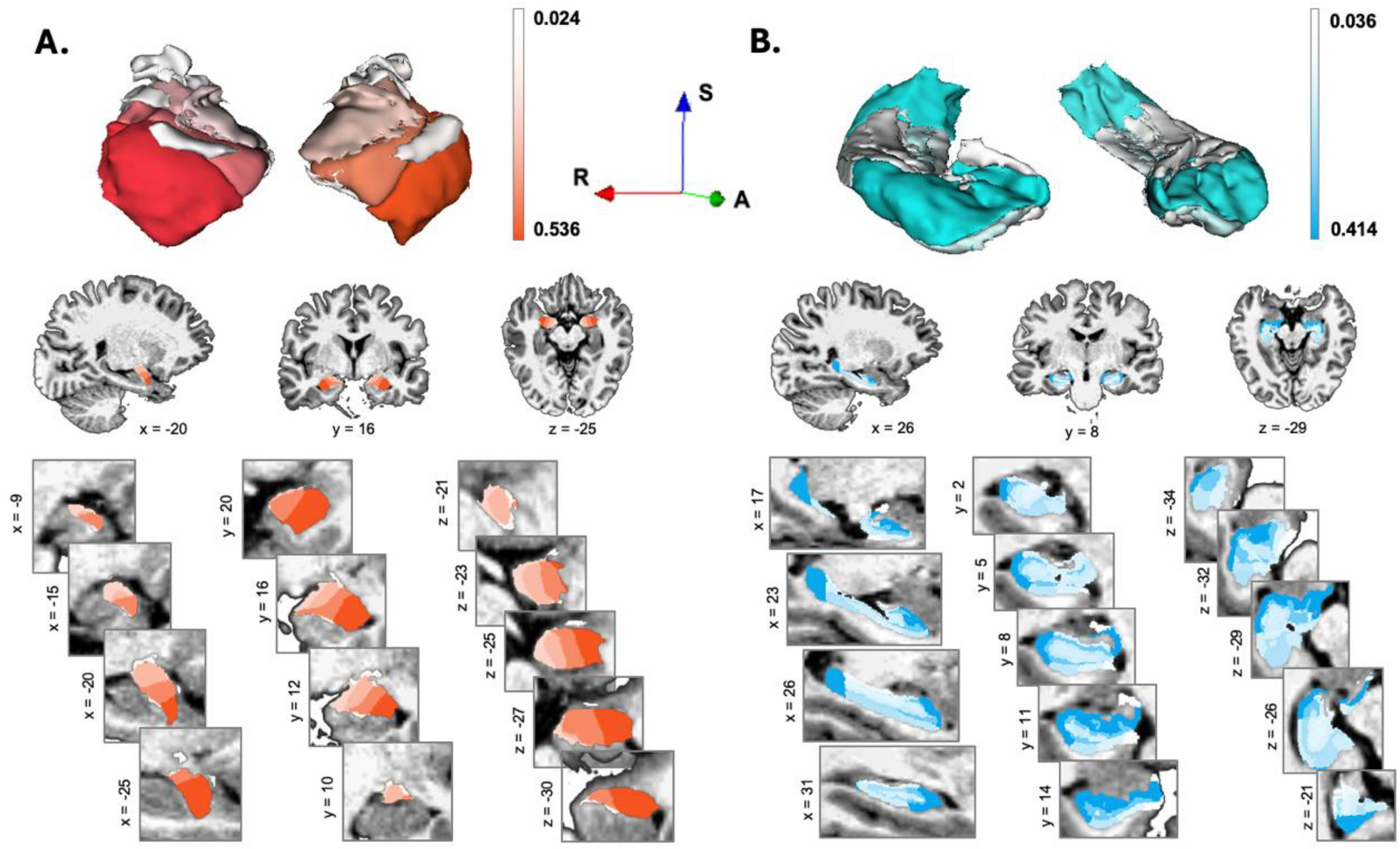 Subcortical brain volume variations in autistic individuals across the lifespan