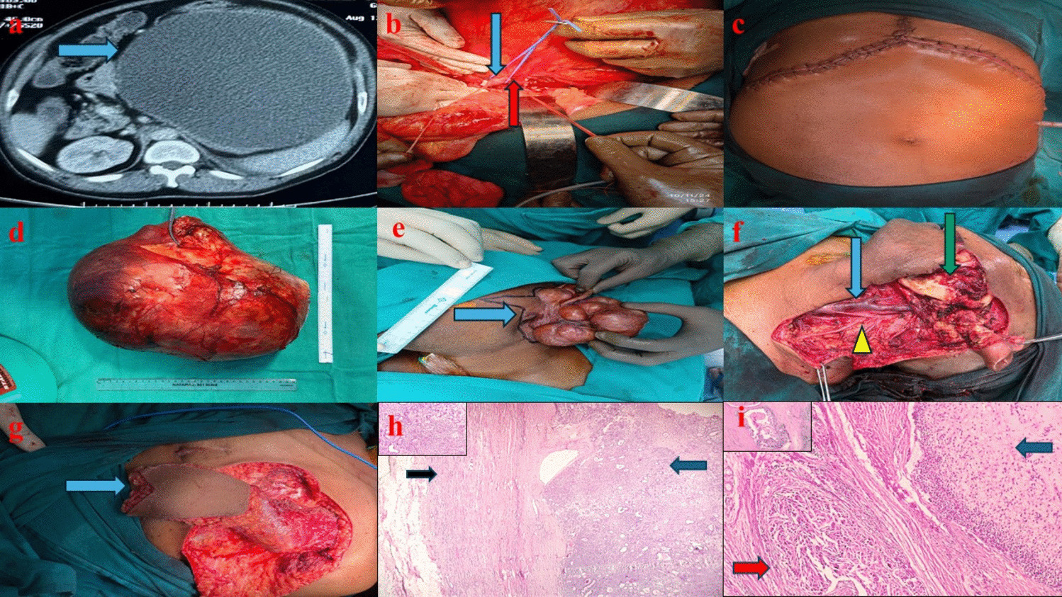 A Medical Marvel And Complex Clinical Scenario: The Largest Documented Case of Renal Metastasis from Pleomorphic Adenoma, Weighing 13.5 kg
