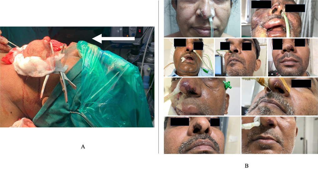 Preventing Nasal Alar Necrosis in Oral Cancer Patients: A Quality Improvement Initiative for Safer Nasotracheal Intubation at a Tertiary Cancer Centre