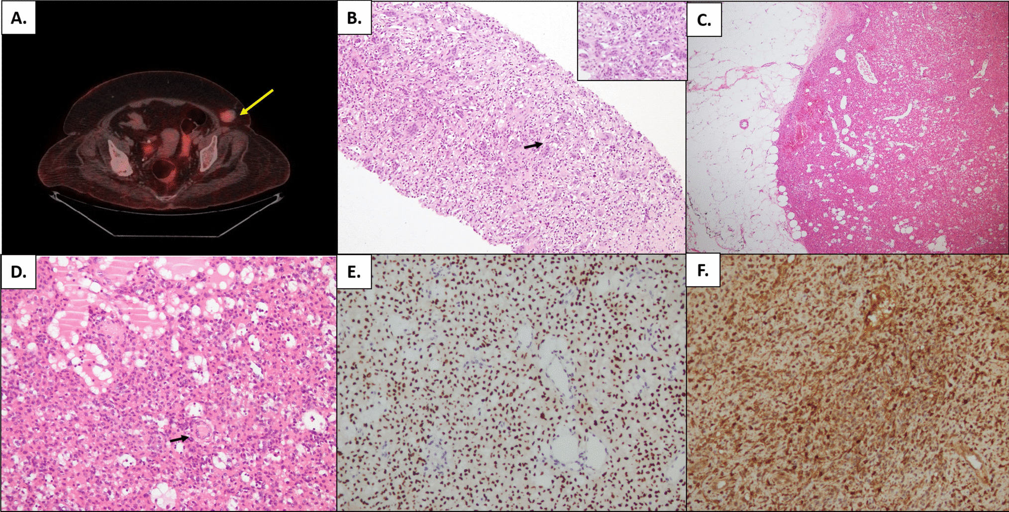 Phosphaturic Mesenchymal Tumor Masquerading as Giant Cell Tumor in an Elderly Woman: A Diagnostic Challenge