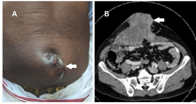 Isolated Abdominal Wall Recurrences in Colorectal Cancer: A Case Series and Review of Literature