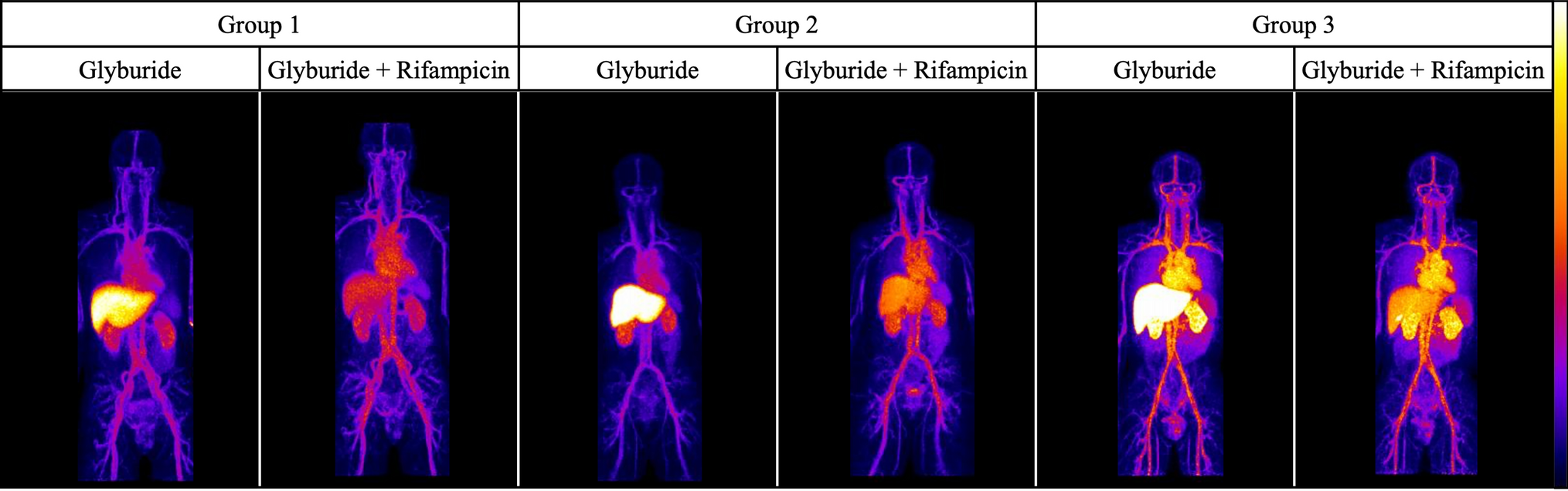 Modeling Whole-Body Dynamic PET Microdosing Data to Predict the Whole-Body Pharmacokinetics of Glyburide in Humans