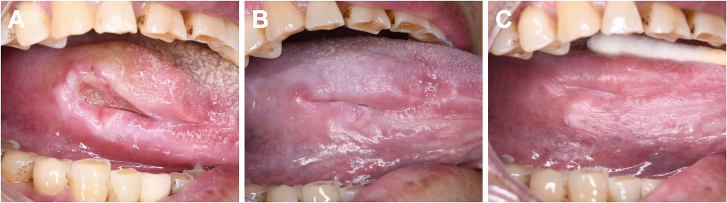 Corticosteroid injection for pyogenic granuloma of the tongue in a rare resembling ulcerative malignancy: a case report