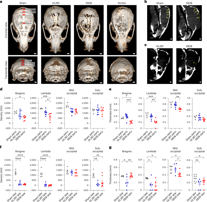 Brain tumors induce widespread disruption of calvarial bone and alteration of skull marrow immune landscape