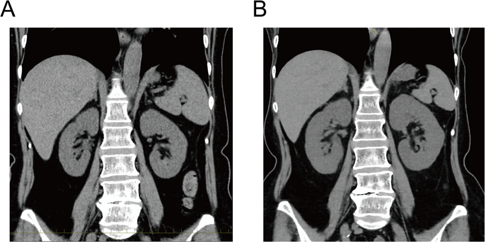 Abemaciclib-associated acute interstitial nephritis successfully treated with glucocorticoids: a case report and literature review