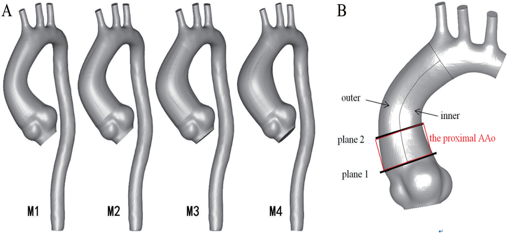 Hemodynamic characteristics of dilated ascending aorta in patients with bicuspid aortic valve