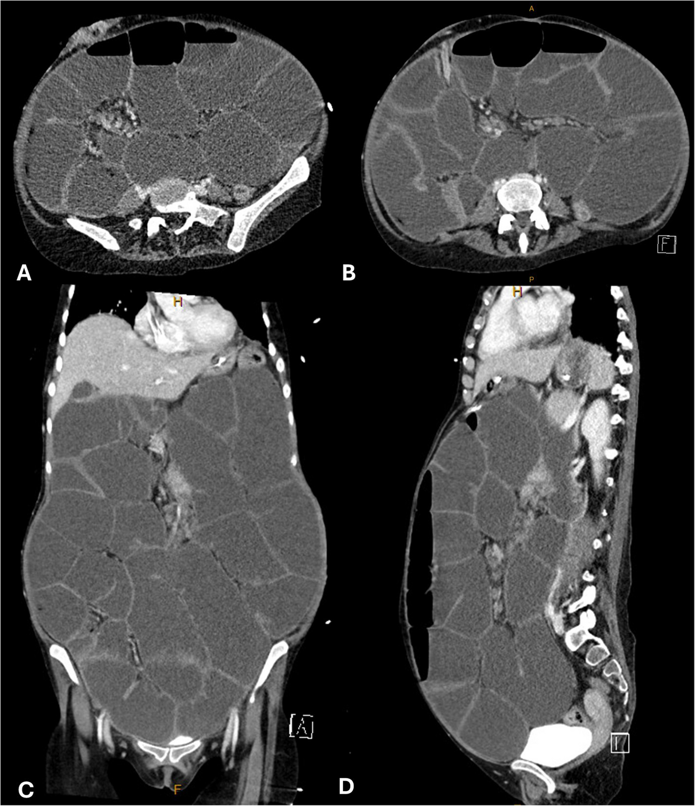 Pain management in a patient with intestinal failure in the palliative care setting: case report