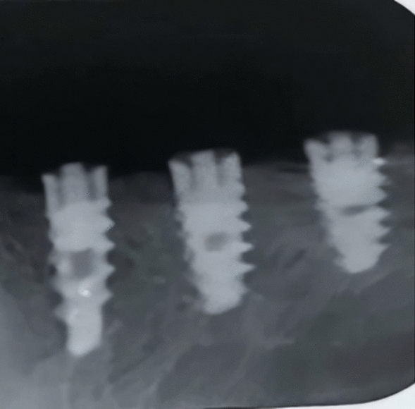 Sadhwani Technique: A Simple and Innovative Method for Retrieving Broken Abutment Screw