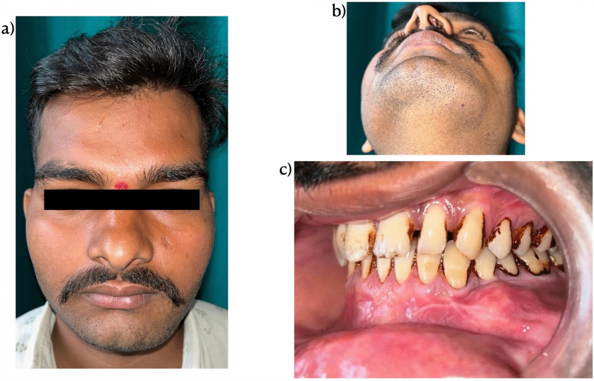 Aneurysmal Bone Cyst of The Mandible: A Rare Case Report