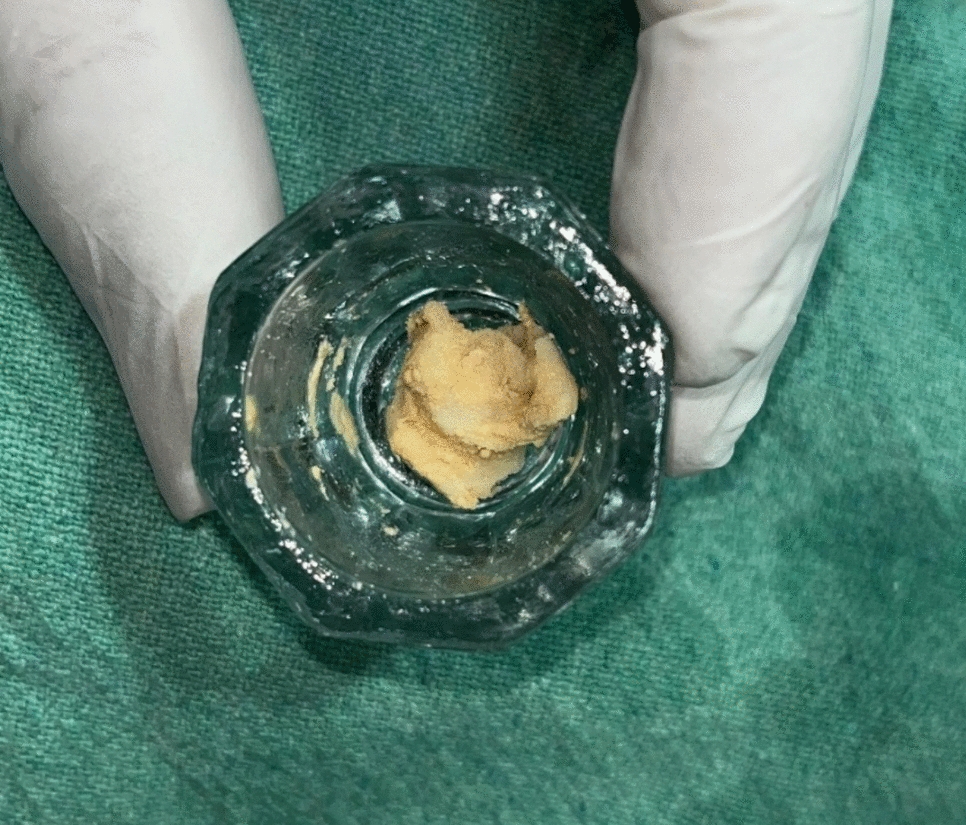 Simvastatin Outperforms Melatonin in Early Alveolar Bone Regeneration Following Mandibular Third Molar Extraction: A Prospective Split-Mouth Study