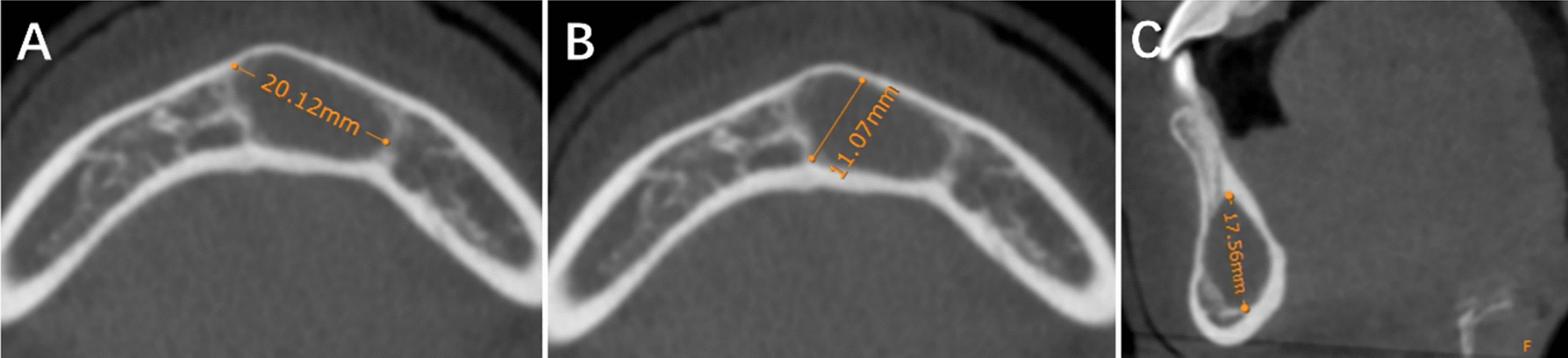 Simple Bone Cysts of the Jaw: A Comprehensive Study of Clinical Features, Imaging, Pathology, and Surgical Outcomes