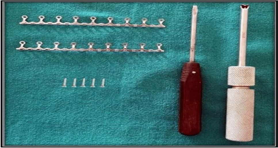 Comparison of Bone Supported Hybrid Arch Bar with Erich’s Arch Bar for Intermaxillary Fixation in Facial Fractures. A Comparative Prospective Randomized Clinical Study