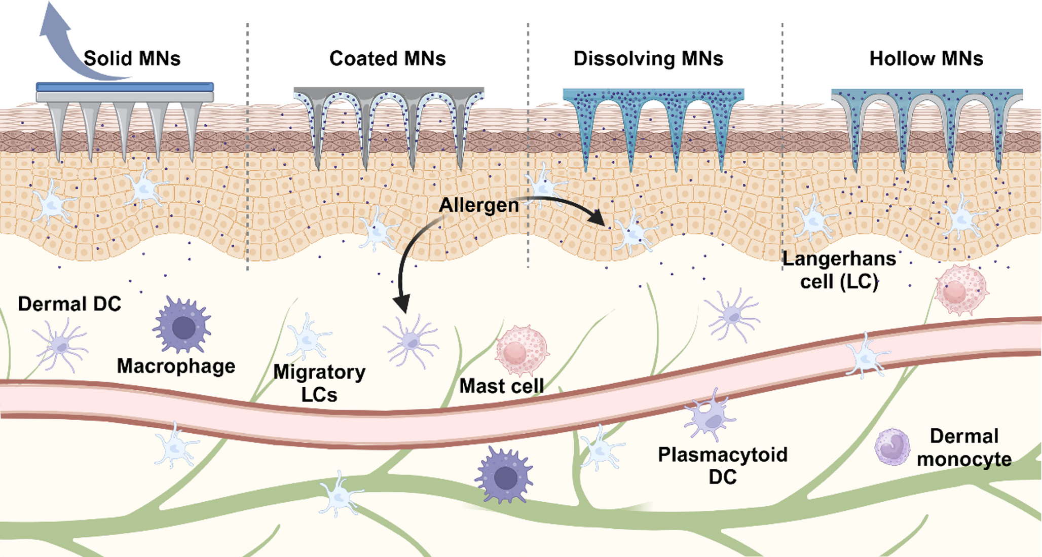 Microneedles in Allergy Immunotherapy: the Present and Future