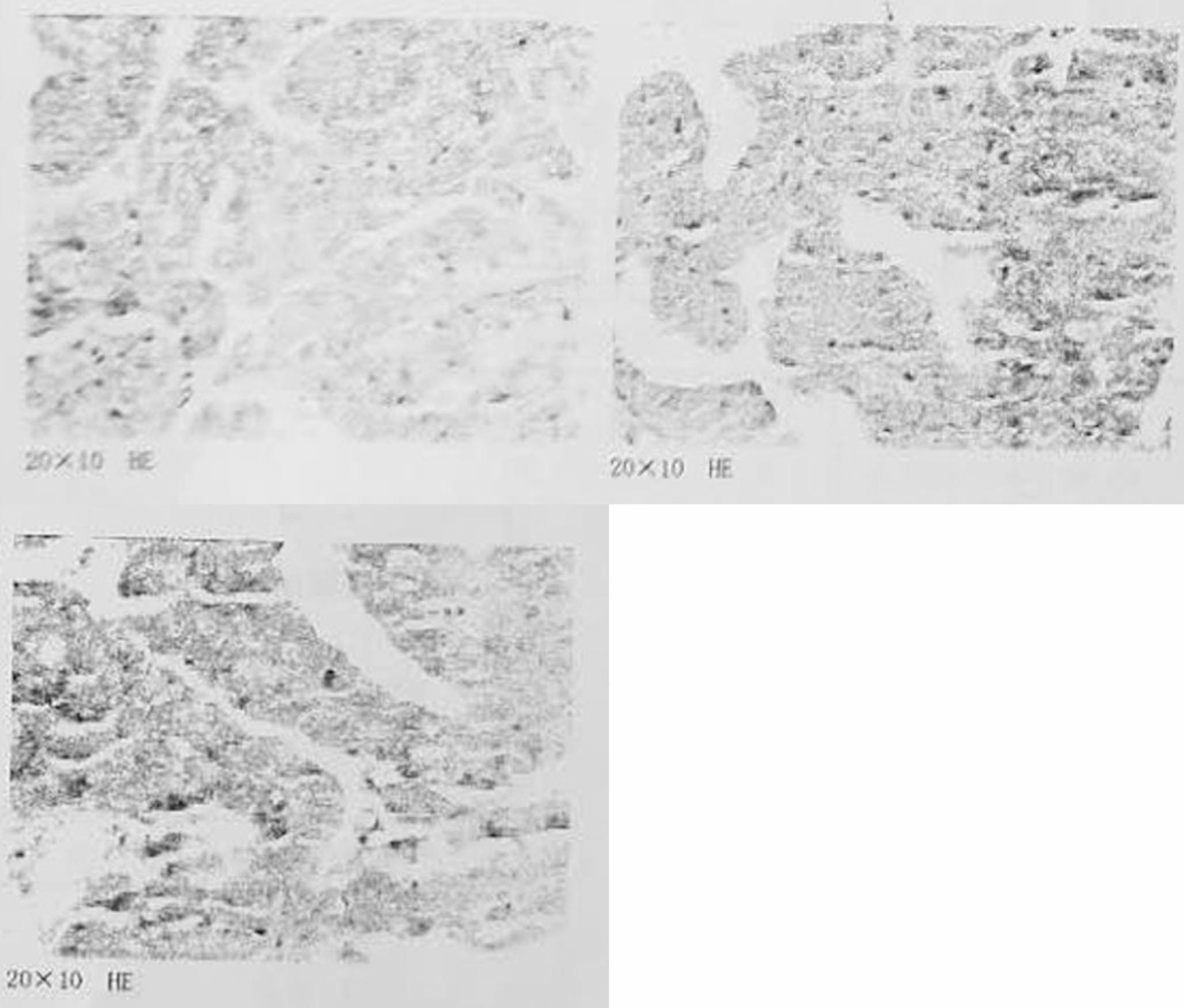 A clinical report and analysis of metachronous multiple primary cancers occurred in four sites
