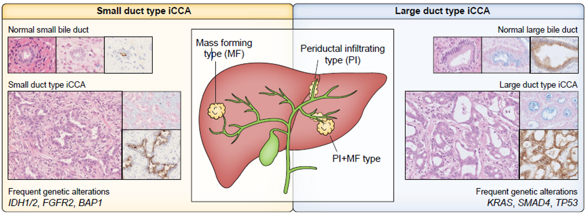 Intrahepatic cholangiocarcinoma as a unique subtype: key updates from current guidelines
