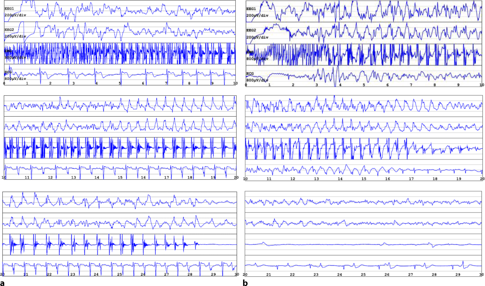 Recorded spontaneous seizure prior to electroconvulsive therapy after etomidate induction in a patient treated with bupropion: a case report
